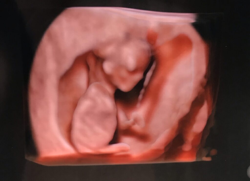 13週胎児3Dエコー