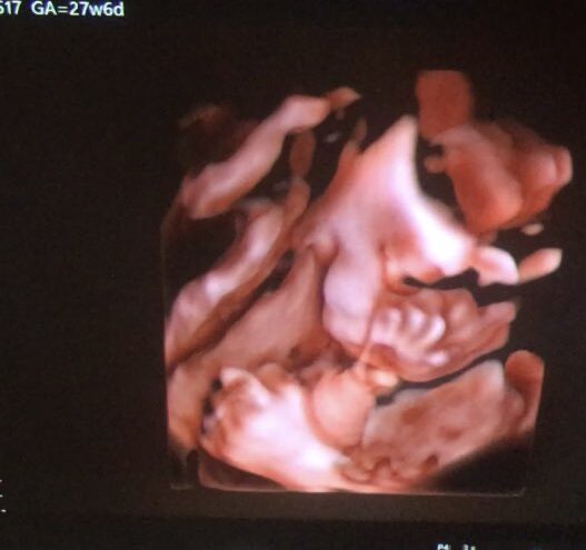 28週胎児3Dエコー