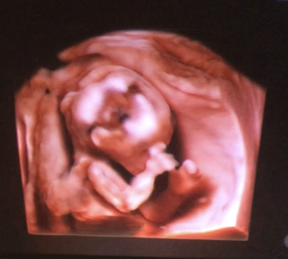 16週胎児3Dエコー